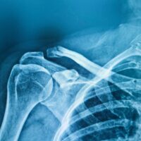 Film,Right,Cavicle,Ap,Views.,Comminuted,Fracture,At,Distal,Right