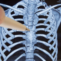 Sternum,And,Thymus,Gland.,Doctor,Points,Out,Ballpoint,Pen,On